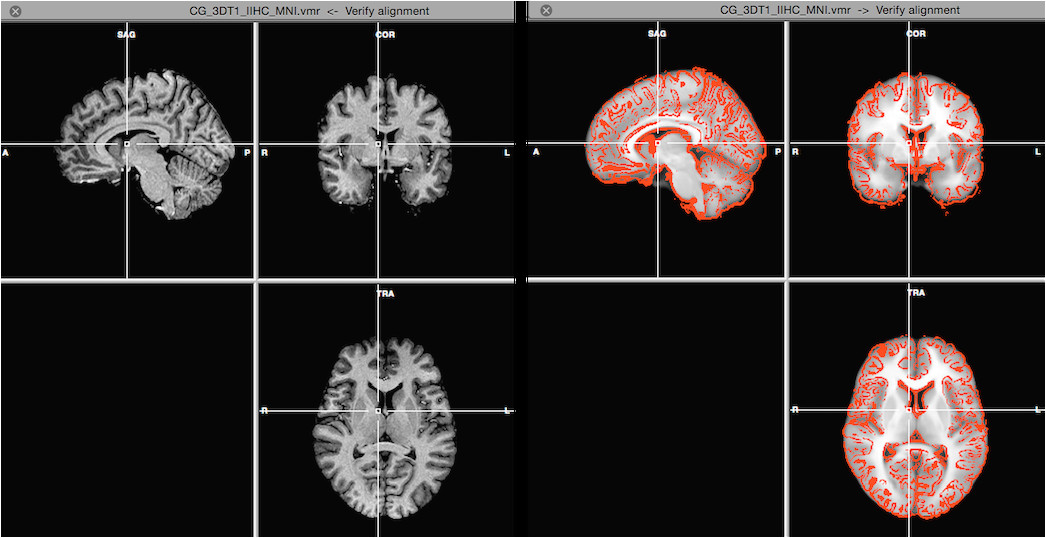 Mni Template Mni normalization