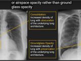 Left Cardiac Border X Ray 204 Best Radio Chest Images In 2020 Radiology Radio Chest