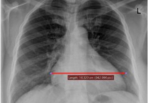 Left Cardiac Border X Ray Cardio Thoracic Ratio is Stable Reproducible and Has