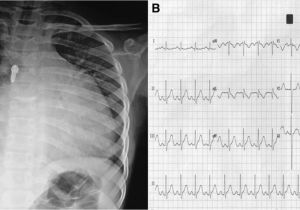 Left Cardiac Border X Ray Giant Multiloculated Left Ventricular Outflow Tract