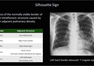 Left Cardiac Border X Ray How to Interpret A Chest X Ray Lesson 8 Focal Lung