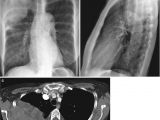 Left Cardiac Border X Ray Lungs Mediastinum and Pleura Springerlink