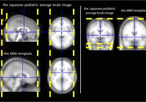 Mni Template A Study Of the Standard Brain In Japanese Children