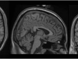 Mni Template Bic the Mcconnell Brain Imaging Centre Colin 27