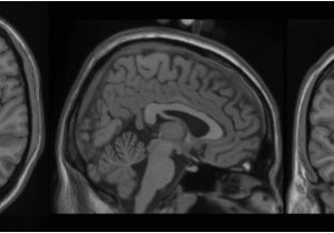 Mni Template Bic the Mcconnell Brain Imaging Centre Colin 27