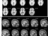 Mni Template Frontiers Age Specific Mri Brain and Head Templates for