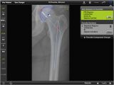 Orthopedic Templating software Biomet orthosize Templating On the App Store