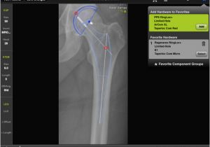 Orthopedic Templating software Biomet orthosize Templating On the App Store