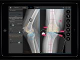 Orthopedic Templating software Brainlab Increases Automation In orthopedic Digital