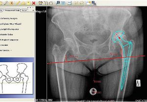 Orthopedic Templating software Hip Replacement Template for orthopedic Surgery
