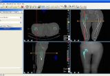 Orthopedic Templating software Surgical Medical software for orthopedic Templating Flickr