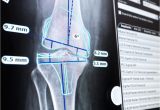Orthopedic Templating software Traumacad Digital orthopedic Templating by Brainlab