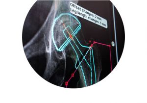 Orthopedic Templating software Traumacad Digital orthopedic Templating by Brainlab