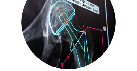 Orthopedic Templating software Traumacad Digital orthopedic Templating by Brainlab