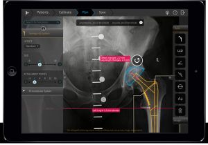 Orthopedic Templating software Traumacad Mobile Hip Replacement Planning for Ipad Scores