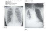 Right Cardiac Border X Ray A Gray S Anatomy Review Abrahams Peter H Pages 51 100