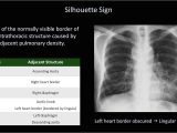 Right Cardiac Border X Ray How to Interpret A Chest X Ray Lesson 8 Focal Lung