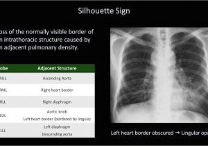 Right Cardiac Border X Ray How to Interpret A Chest X Ray Lesson 8 Focal Lung