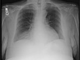 Right Cardiac Border X Ray Morgagni Hernia Radiology Case Radiopaedia org
