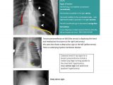 Right Cardiac Border X Ray Tension Pneumothorax Docx Lung Thorax