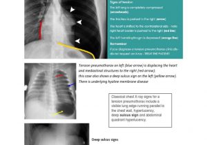Right Cardiac Border X Ray Tension Pneumothorax Docx Lung Thorax