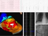 Right Cardiac Border X Ray Ventricular Tachycardia 2019 Journal Of Arrhythmia